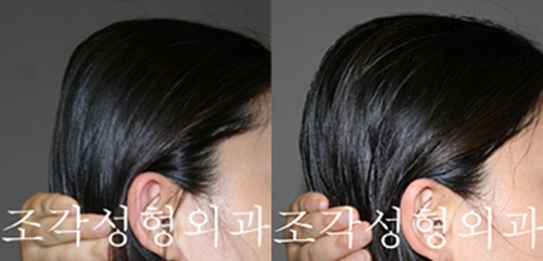 韩国雕刻医院骨水泥填充后脑勺术前术后