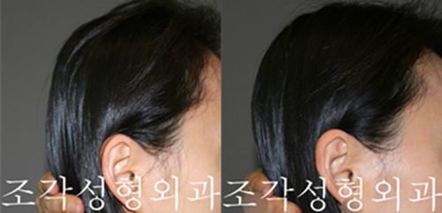 韩国雕刻医院宋龙泰骨水泥填充后脑勺填充术前术后