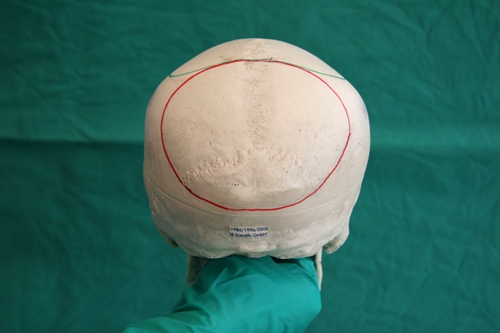 韩国雕刻整形医院骨水泥填充后脑勺手术