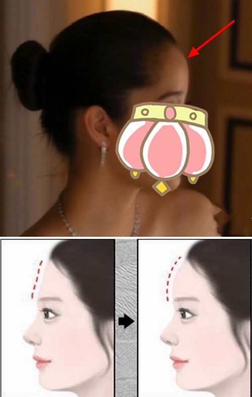 韩国人偏好的额头审美是什么样的？骨水泥填充额头是否可以做出额结节？