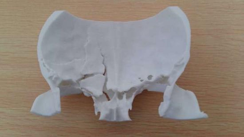 3D颅骨打印技术