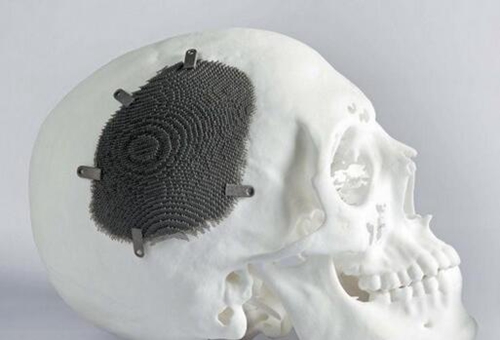 3D颅骨打印技术