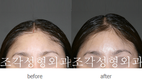 韩国雕刻医院宋龙泰骨水泥填充头顶术前术后对比照