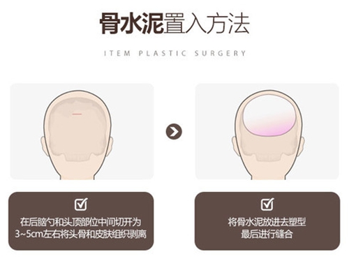 骨水泥的置入方法