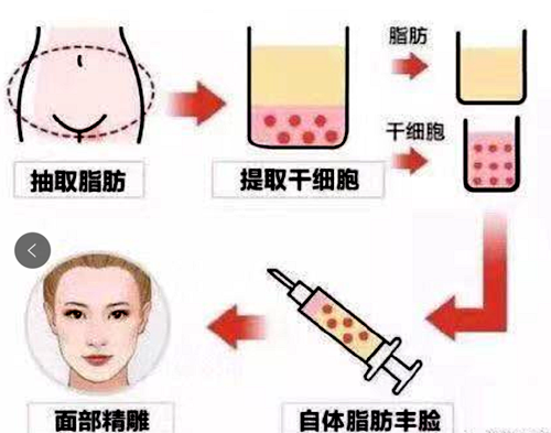 自体脂肪填充过程示意图