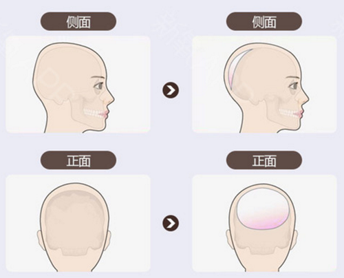 韩国雕刻整形医院骨水泥填充的区域