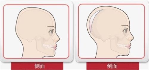 骨水泥填充后脑勺示意图