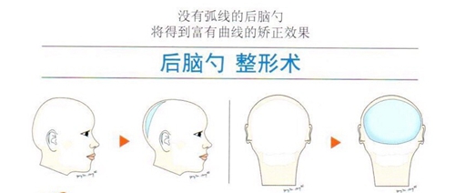 韩国雕刻整形医院后脑勺整形术