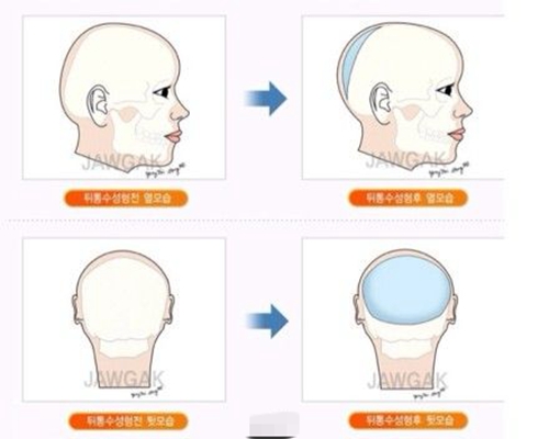 韩国雕刻整形医院头部整形