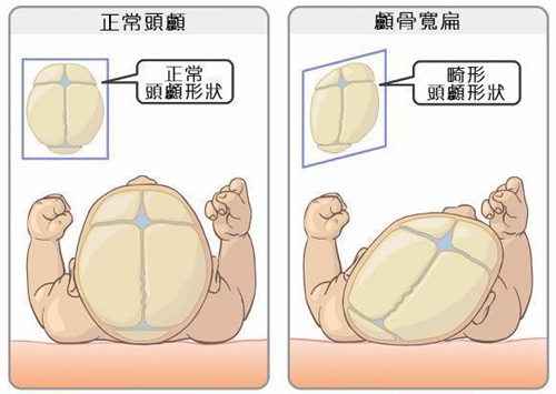 骨水泥填充手术