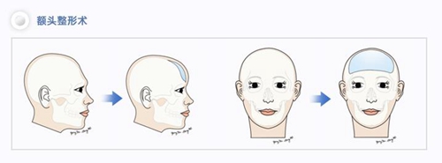 韩国雕刻整形医院骨水泥填充额头手术