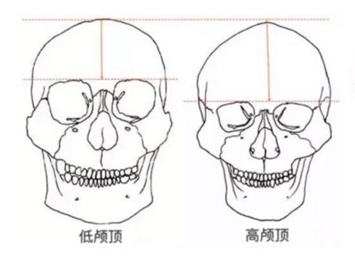 高颅顶与低颅顶的区别